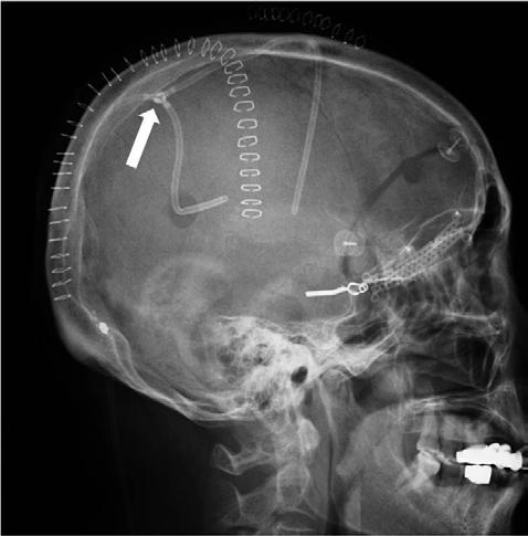 JAE YOUNG CHOI ET AL temporo-occipital scalp for cyst access and another linear incision was made on the right Kocher's point for ventricular access by an intraoperative neuro-navigation system.