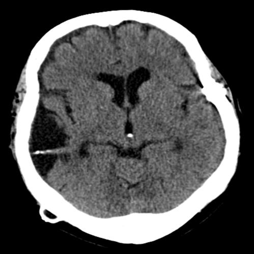 Follow-up CT performed at one year post-operatively showed proper positioning of the shunt components and an interval improvement in brain condition including the hydrocephalus (Fig. 6).