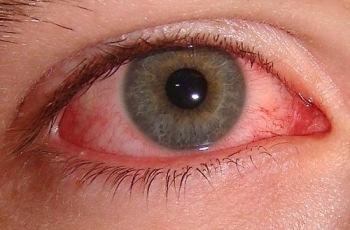 2 weeks later Abdominal pain has subsided Red eyes.