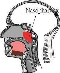 H&N TUMORS: Nasopharyngeal Carcinoma Because the nasopharynx is