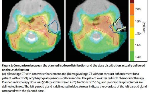 ADAPTIVE RT Volumetric and positional changes of organs at risk and target volumes are generally associated with progressive increase in the delivered dose compared with the planned dose, typically