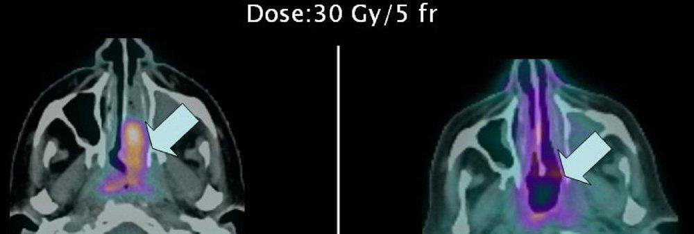 Fig. 2 Case 2: Direct comparison of PET/CT images before and 6 months after the SBRT treatment (30 Gy in 5 fractions), showing