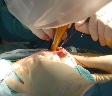 INTRABEAM System Surgeon performs lumpectomy Surgeon sizes the cavity for the appropriate applicator The INTRABEAM systems is draped and applicator is affixed to the