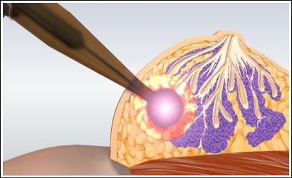 INTRABEAM System radiotherapy delivered directly into the tumor bed at the time of surgery