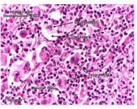 Hodgkin s Disease Hodgkin's disease is a group of cancers characterized by Reed Sternberg cells in an