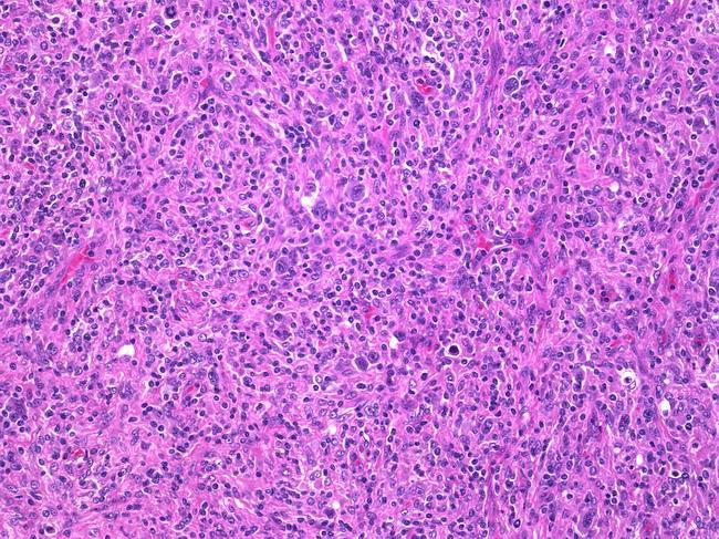 Mixed Cellularity Type Mixed Cellularity type accounts for 20% to 25% of cases of Classical Hodgkin s Lymphoma.