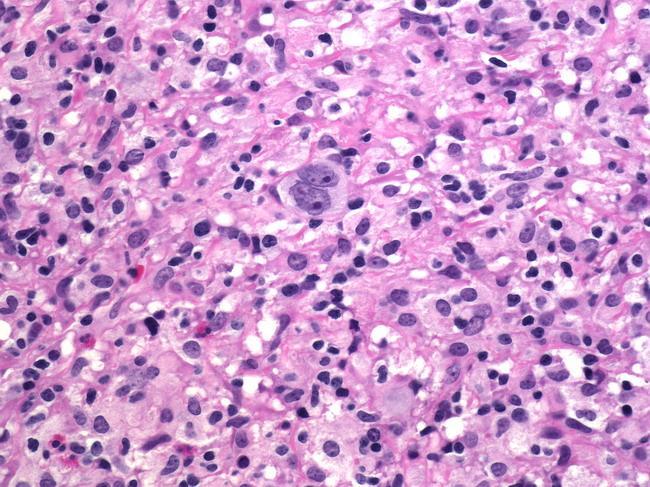 Lymphocyte depleted A Reed-Sternberg cell is seen in a background of eosinophils, lymphocytes, and macrophages.