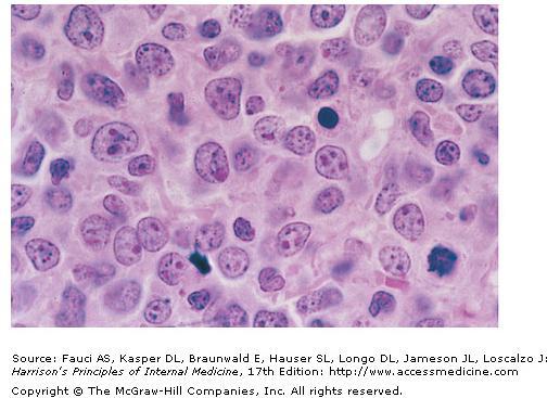 Diffuse B-cell lymphoma The neoplastic cells are heterogeneous but