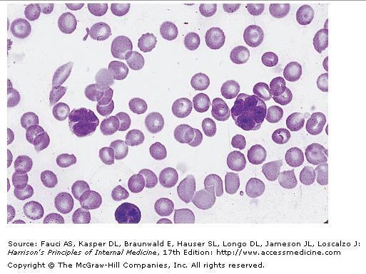 Adult T-cell Lymphoma (leukaemia) Peripheral blood smear