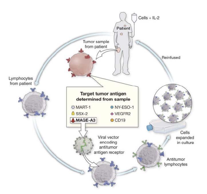 Schema: Personalized / Precision immunotherapy using gene modified cells Cells + IL-2 Tumor sample from patient Reinfused Lymphocytes from
