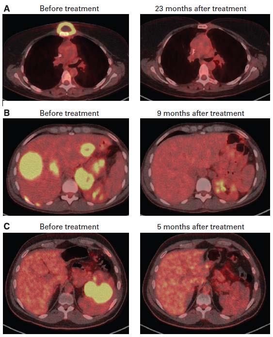Anti-CD19 CAR-T cell Rx in NHL Primary mediastinal NHL Primary mediastinal