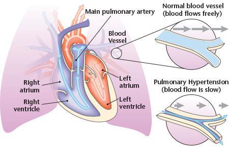 Pulmonary Arterial