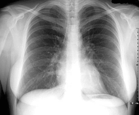 The Normal Chest XRAY Central Airways