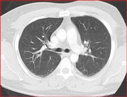 Normal CT Images Right Lung Left Lung Heart and Main Blood vessels Bronchial