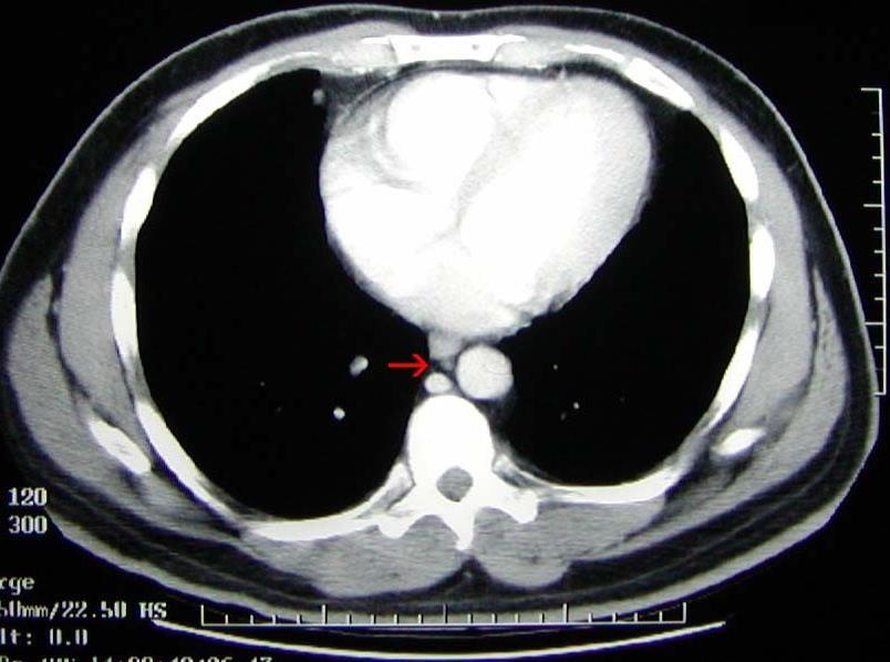 Normal CT Images Heart and Main Blood vessels Pleural Space