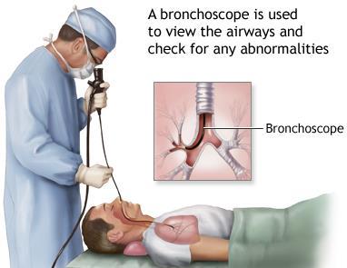 Bronchoscopy Flexible