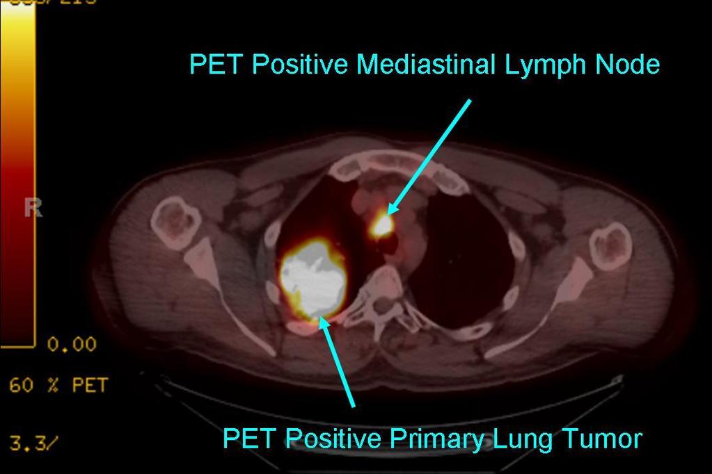 PET Scan Right
