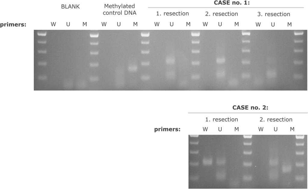 Lhotska et al. Molecular Cytogenetics (2016) 9:13 Page 9 of 10 Fig. 5 Verification of MLH3 promoter methylation by MS-PCR.