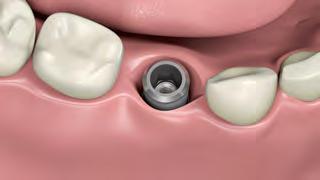 A time-saver, enhanced patient comfort and fewer implant