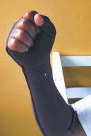 Use compression and dressing wraps to help mobilize oedema back into the circulation. Avoid additional injuries when doing daily activities.