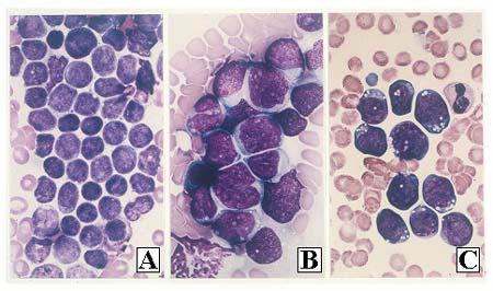 Disease Information Samples of stained bone marrow aspirations
