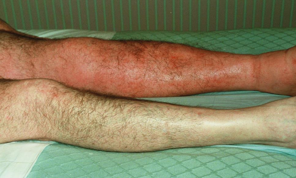 Assessment and management of cellulitis