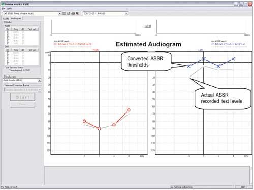 Most ASSR equipment provides correction tables for converting measured ASSR thresholds to estimated HL audiograms.