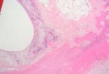 Histolocal classification of nephroblastoma (SIOP)