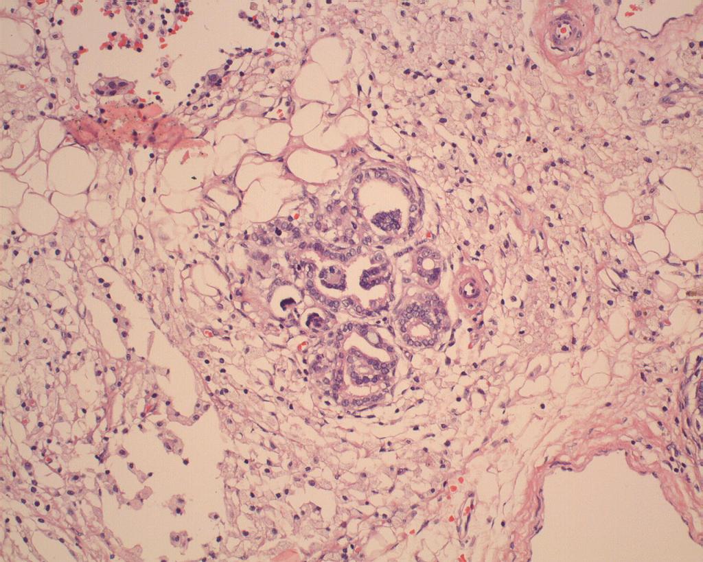 Perilobar nephroblastomatosis