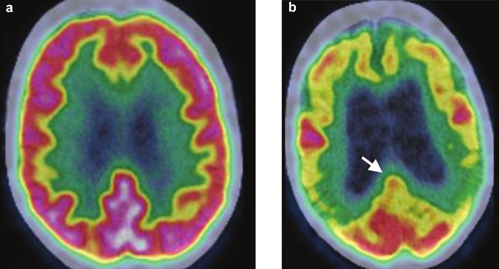 Fig 1. Axial images of FDG PET distribution in the brain at the level of the body of the lateral ventricles. Both patients presented with possible early dementia and MMSE scores of 28/30.