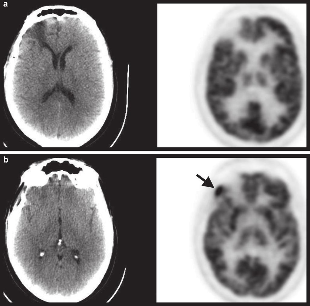 Fig 3. Two axial PET/CT images in a patient with a past history of high-grade oligodendroglioma of the right frontal lobe previously treated with chemoradiotherapy.