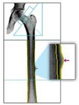 brim. Orthopedic Hip Implant Measure the delicate region around the hip implant and visualizes 19 Gruen zones.