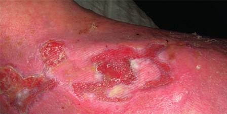 Increased erythema Pyrexia Abscess/pus Local warmth Wound breakdown