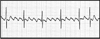 Atrial fibrillation (AF) or atrial flutter They have similar precipitating factors, consequences, and drug therapy.