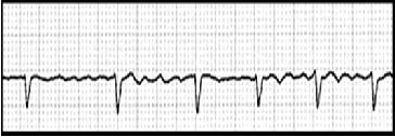 AF More common extremely rapid (400 to 600 atrial beats/min) & irregular atrial activation.
