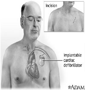 TREATMENT OF ARRHYTHMIA The use of antiarrhythmic drugs in USA is