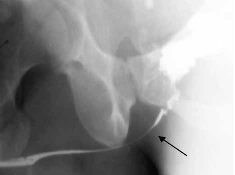 12 The endoscopic treatment of urethral stricture is associated with high recurrence rates (30% 80%).