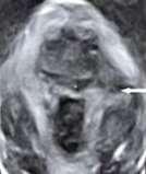 configuration vagina with posterior displacement