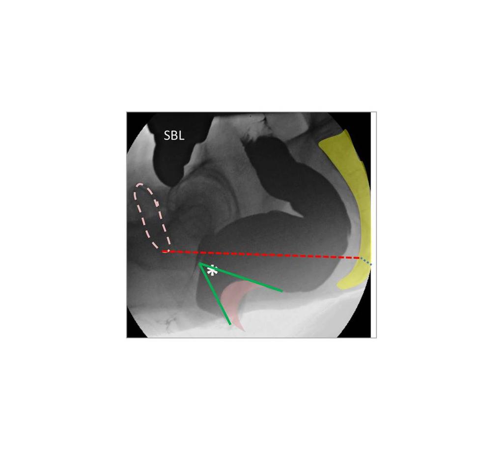 Fig. 6: Relevant pelvic anatomy. Symphysis Pubis (dotted pink line).