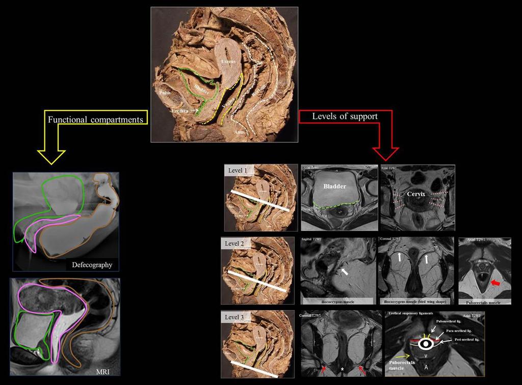 Fig. 2: Cadaveric female pelvis with imaging correlation of the functional compartments and levels of support. Green - anterior compartment; Pink - middle compartment; Brown - posterior compartment.