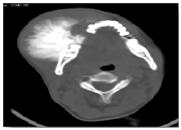 PLAIN & CONTRAST AXIAL CT An ill defined hyperdense bony lesion with few lytic areas within it, arising from buccal surface of right ramus of mandible causing cortical destruction with typical