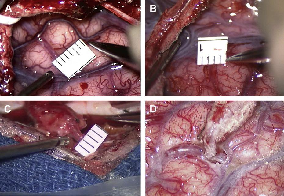 Direct Bypass Techniques 569 Fig. 5. Intraoperative view of a 1-mm (A) and 0.6-mm (B) M4 branch of the MCA on the cortical surface.