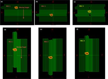 Challenges with VMAT extension to TMAT optimization Standard MLC leaf position interpolation used with VMAT progressive sampling is not directly applicable to TMAT optimization for arbitrary