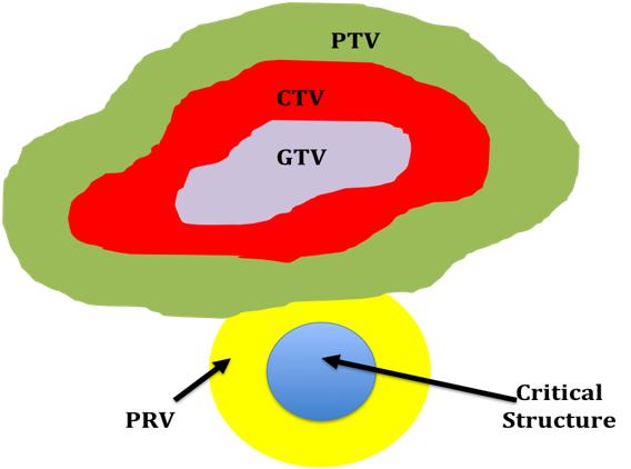 Figure 2: Diagram of the contoured volumes used for tumor delineation. The planning target volume (PTV) is surrounded by the clinical target volume (CTV), which envelops the gross target volume (GTV).