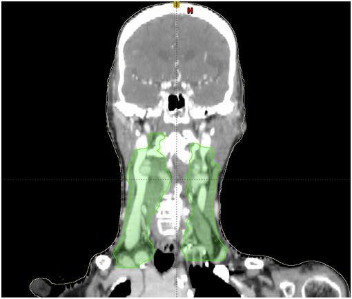2. Materials and Methods 2.1 Patient Selection Ten patients with head-and-neck cancer with bilateral lymph node involvement were selected for this planning study.
