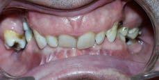 1.Initial periodontal assessment & stabilization 2.
