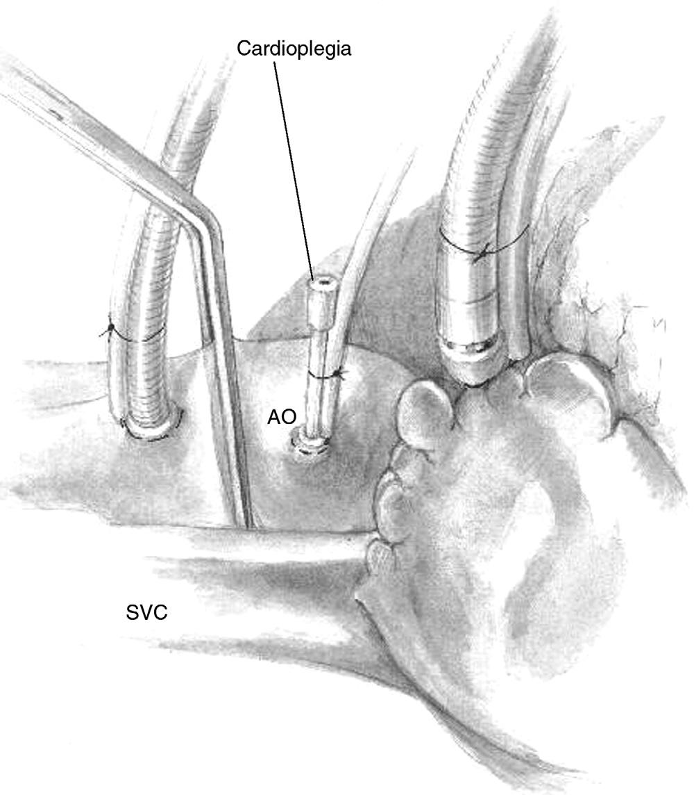 288 R.A. Jonas Figure 2 After 5 minutes or so of cooling so that the myocardial temperature is less than 25 C, the aortic cross-clamp is applied and cardioplegia is infused into the aortic root.