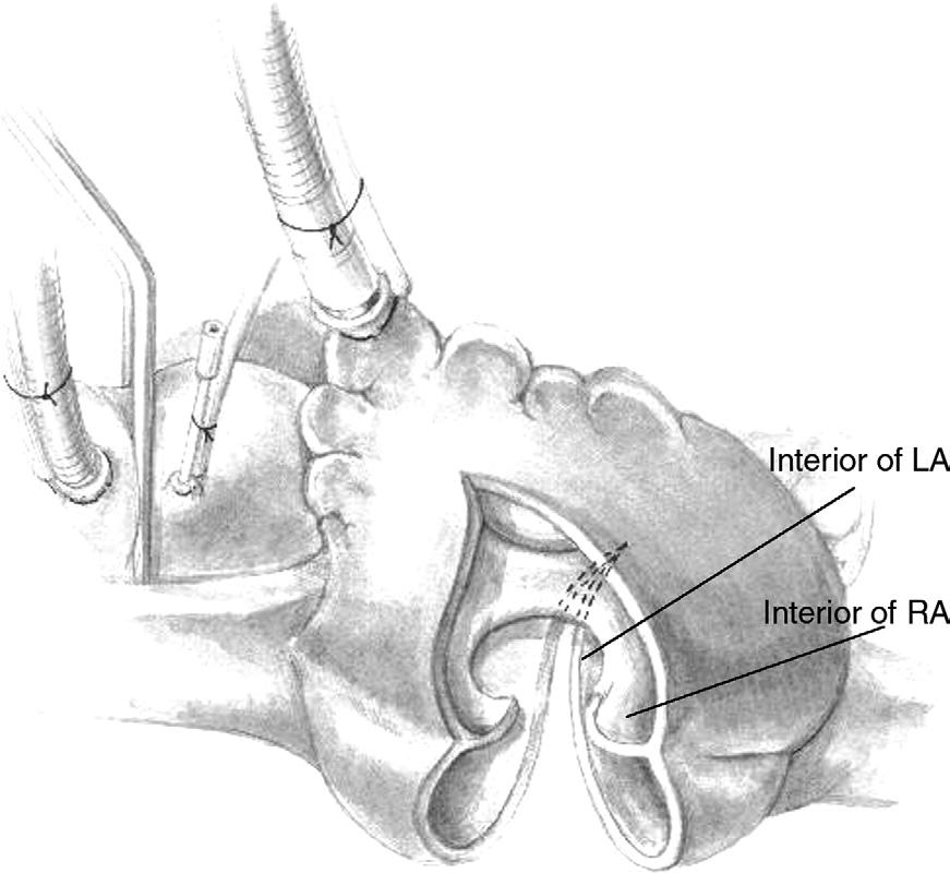 The incision is at the level of the foramen ovale and some distance below the sinus node.