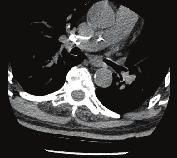 2 Case Reports in Orthopedics (a) (b) (c) Figure 1: (a) An axial cut of the chest CT-scan of a nonenhanced CT chest showing multiple linear and extremely dense bone cement emboli involving pulmonary