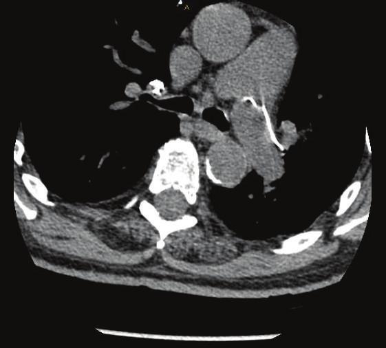 (c) A coronal cut of CT pulmonary angiogram also showing the cement emboli at the pulmonary trunk and right main pulmonary artery. and T12 vertebral bodies under fluoroscopic guidance.